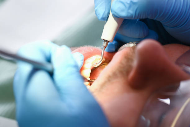 Best Emergency Tooth Extraction in Pleasanton, KS